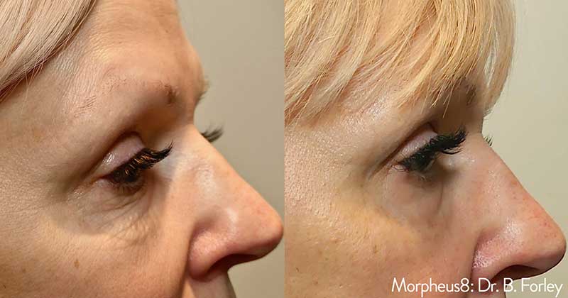 before and after morpheus8 treatment brooklyn